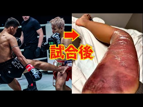 【格闘技】筋断裂！骨折！カーフキック・ローキックで足を破壊された試合6選　【ONE/総合格闘技/K-1/Calf kick】