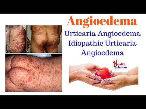 Angioedema - Urticaria Angioedema - Idiopathic Urticaria Angioedema Video