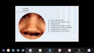 RINITIS, OTITIS Y SINUSITIS