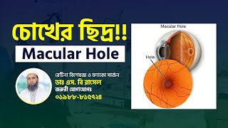 চোখের ছিদ্র | Macular Hole | Patient Review | Retina & Phaco Surgeon | Dr. S B Rasel