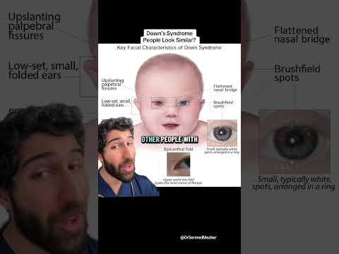 Why Do Down’s Syndrome People Look Similar? #explain