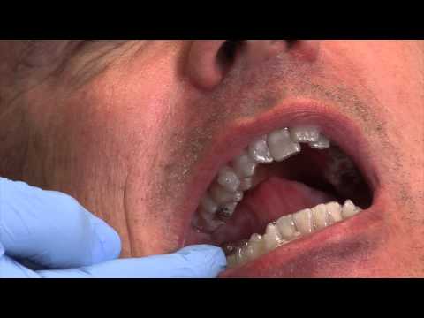 Invisalign - Part 3: Care