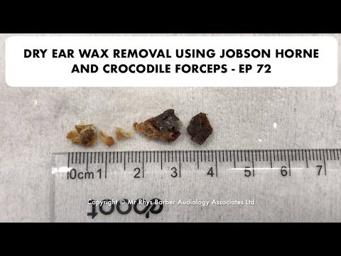 DRY EAR WAX REMOVAL USING JOBSON HORNE AND CROCODILE FORCEPS - EP 72