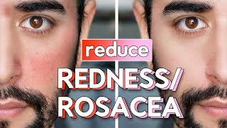 Red Skin & Rosacea On Face - Skin Care Routine, Hacks & Fixes ✖ James Welsh