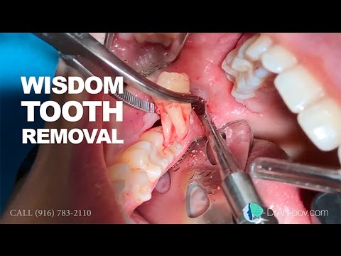 Wisdom tooth removal in 5 MIN or less. Surgical Guide: Online Course + Free e-Book!