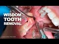 Wisdom tooth removal in 5 MIN or less