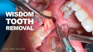 Wisdom tooth removal in 5 MIN or less