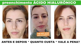 Preenchimento Com ácido Hialurônico Antes E Depois
