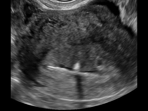 Gestação em usuária de DIU, Achados precoces da ultrassonografia