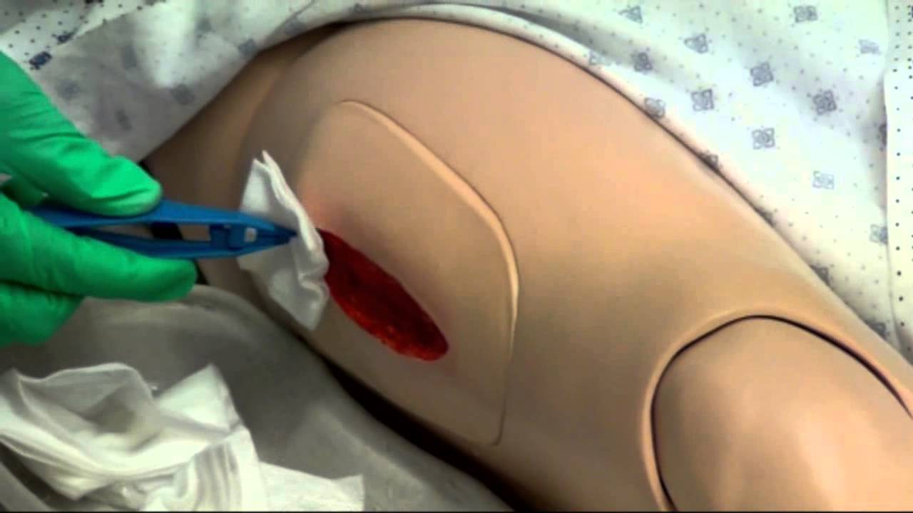 Medicazione lesione da decubito