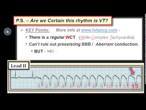 ECG Video-5 (Blog 99) Rhythm Mgmt-Part 2 (10-31.2-2014)