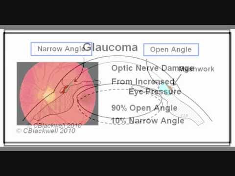Narrow Angle Glaucoma