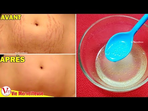 download lagu mp3 mp4 Effacer Les Vergetures Naturellement, download lagu Effacer Les Vergetures Naturellement gratis, unduh video klip Effacer Les Vergetures Naturellement