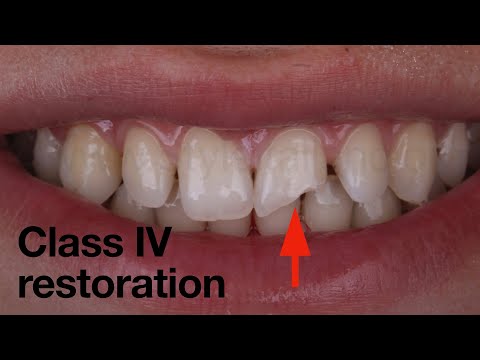 Free hand class IV restoration using simplified approach and unica matrix