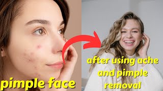 acne controler price in bangladesh।acne treatment।একনি দূর করার উপায়
