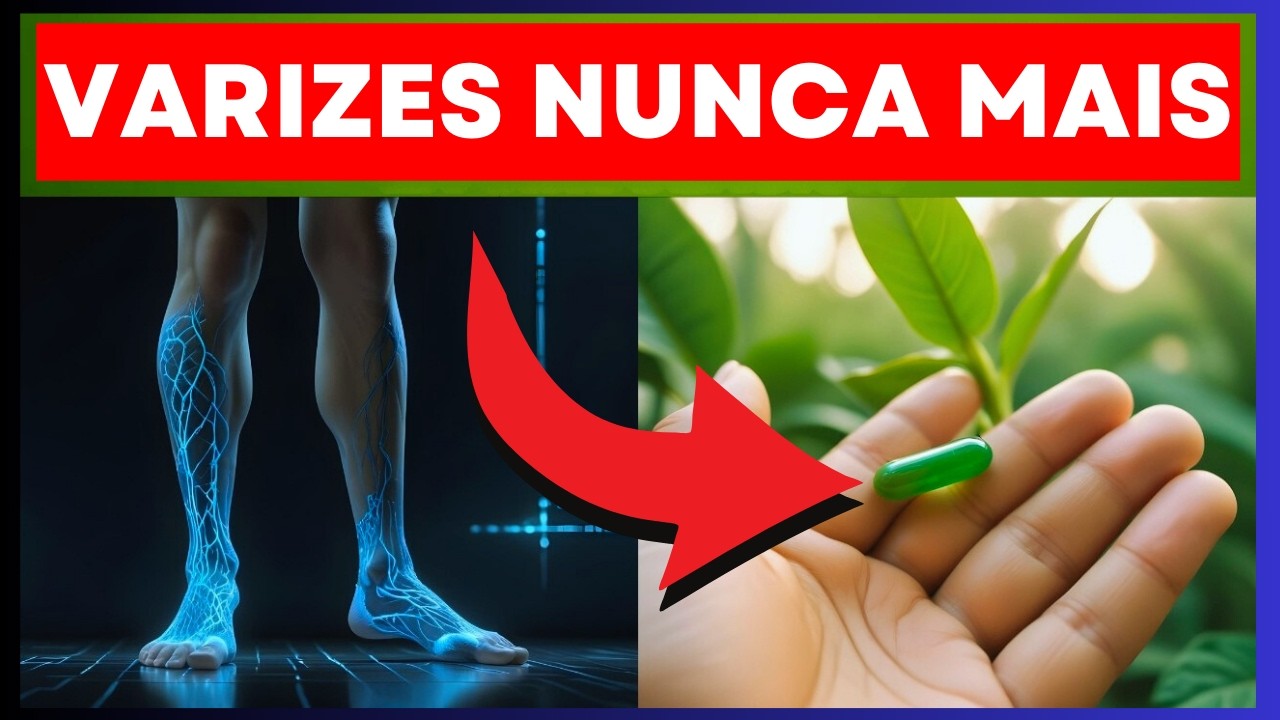 Acabar com as Varizes em 2024 é Fácil e Eu Vou Mostrar Como!