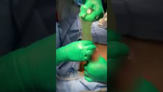Ruptured implant removal
