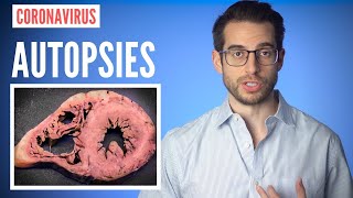 188 COVID 19 Patients Autopsy – Possible Heart Inflammation (Myocarditis)?