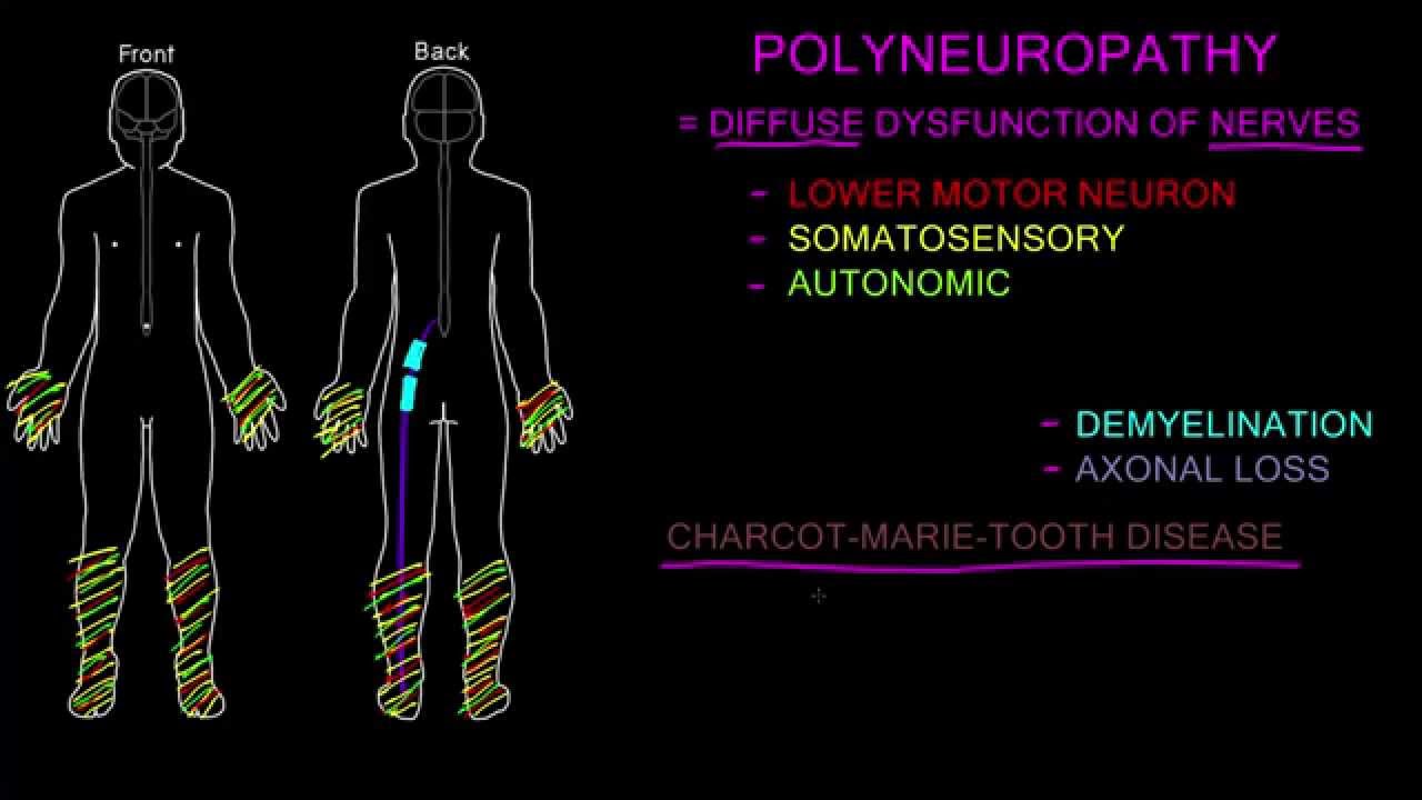 Polyneuropathy - YouTube