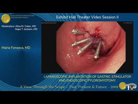 Laparoscopic Implantation of Gastric Stimulator and Endoscopic Pyloromyotomy