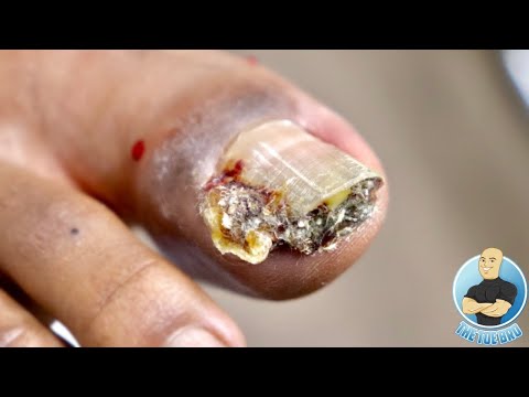 OVERGROWN INFECTED INGROWN TOENAIL REMOVAL ***WITH A SUPER SURPRISE***