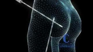 Liposucción, silueta perfecta en Clinimagen - Clinimagen