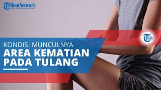 Nekrosis Avaskular, Kondisi Medis yang Serius di Mana Terdapat Area-area Kematian Tulang