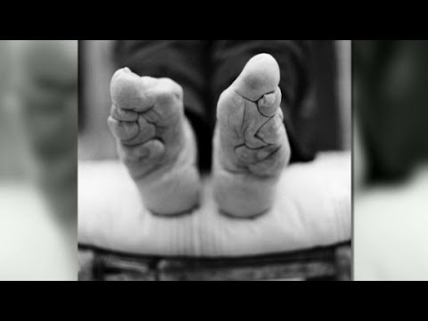 Living with bound feet