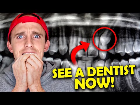 The DANGER of Impacted Canines: Root Resorption