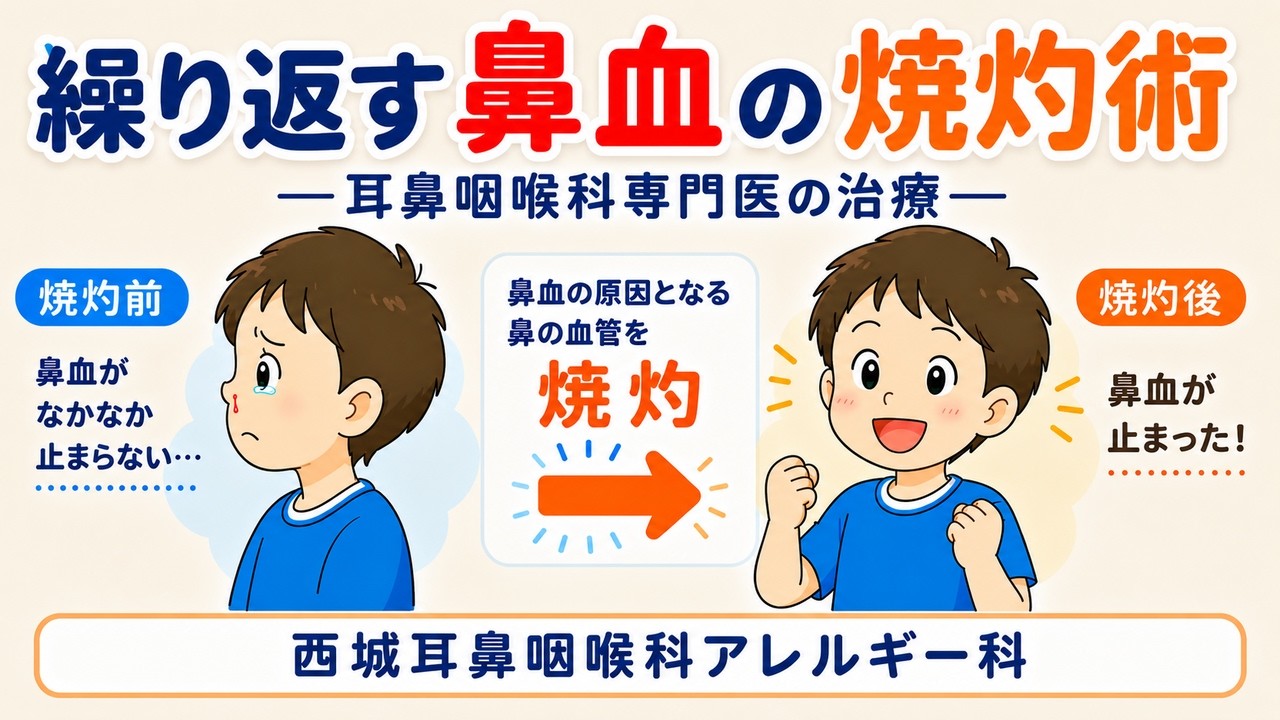 繰り返す鼻血の焼灼術－耳鼻咽喉科専門医の治療－