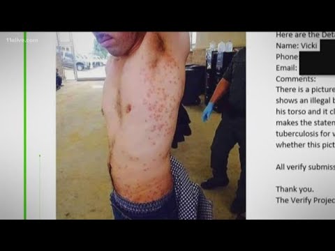 Verify: Did an immigrant cross into the US illegally with smallpox?