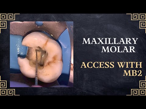 Maxillary Molar Access Opening with MB2