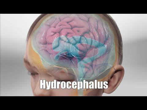 Hydrocephalus 3d Animation