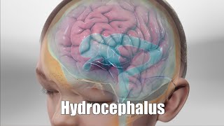 Hydrocephalus