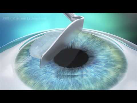 LASEK/PRK - Augenlasern ohne Schnitt