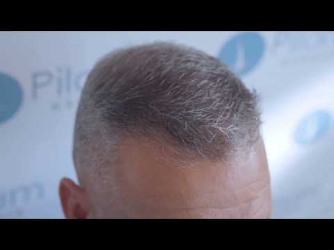 David   behandling af hårtab