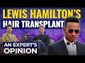 Has Lewis Hamilton Had A Hair Transplant? | Expert's Opinion Has Lewis Hamilton Had A Hair Transplant? | Expert's Opinion