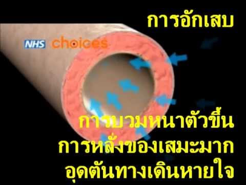กลากบนมือ sinaflana Ladoshechny โรคสะเก็ดเงินที่ฝ่าเท้า