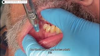 Incisive dental injection