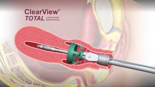 Manipulator maciczny ClearView Total