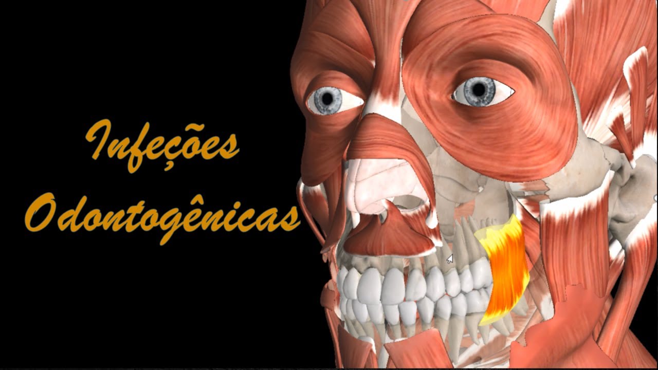 Infecções Odontogênicas - Assista este vídeo para saber diagnosticar e tratar– Aula 1