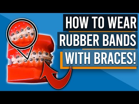 HOW TO WEAR RUBBER BANDS/ELASTICS WITH BRACES!