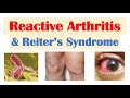 Reactive Arthritis & Reiter’s Syndrome | Causes, Signs & Symptoms, Diagnosis, Treatment