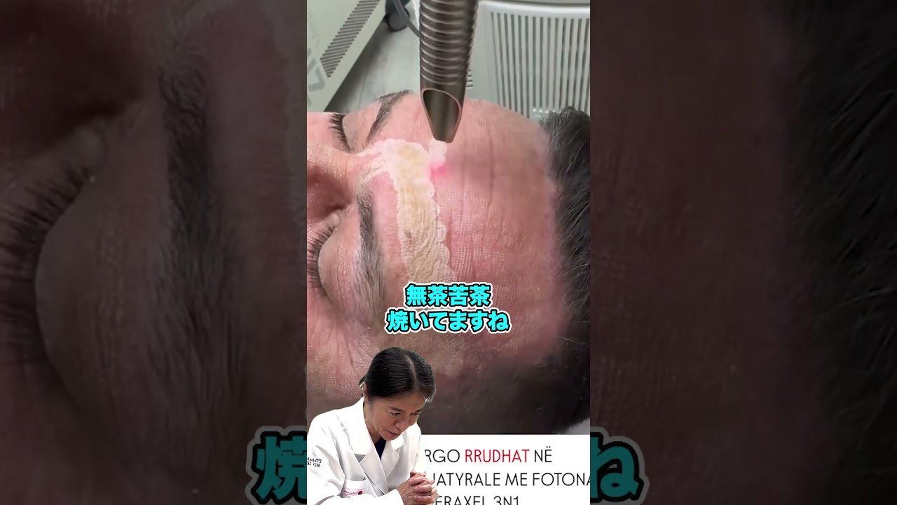 【激しいレーザー治療】シワにここまでやっちゃうの！？日本人なら痕になるほどの荒々しい治療！