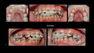 Clinical case of tooth extraction combined with jaw expansion
