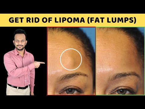 ✅ DO THIS ONCE A DAY & Get Rid Of Lipoma | 3 Natural Ways to Treat Fat Lumps (Lipoma)