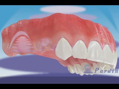 骨拡張器で,インプラントを埋め込む ©