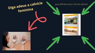 tratamento caseiro para calvcie guia definitivo para o fim da calvcie onde comprar? ATUALIZADO2021