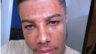 blueface shows off his new black eyes