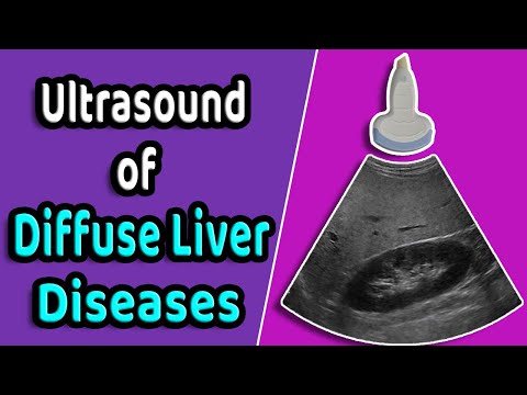 image-What does fatty liver on ultrasound mean?